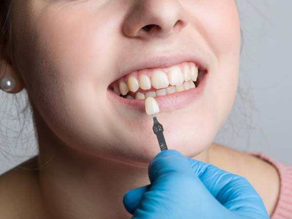 مراحل انجام ونیر کامپوزیت دندان