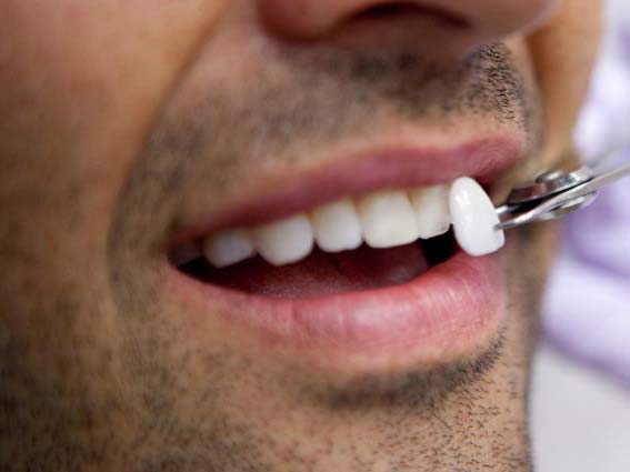 ونیر دندان چیست ؟