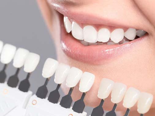 ونیر کامپوزیت دندان چیست؟