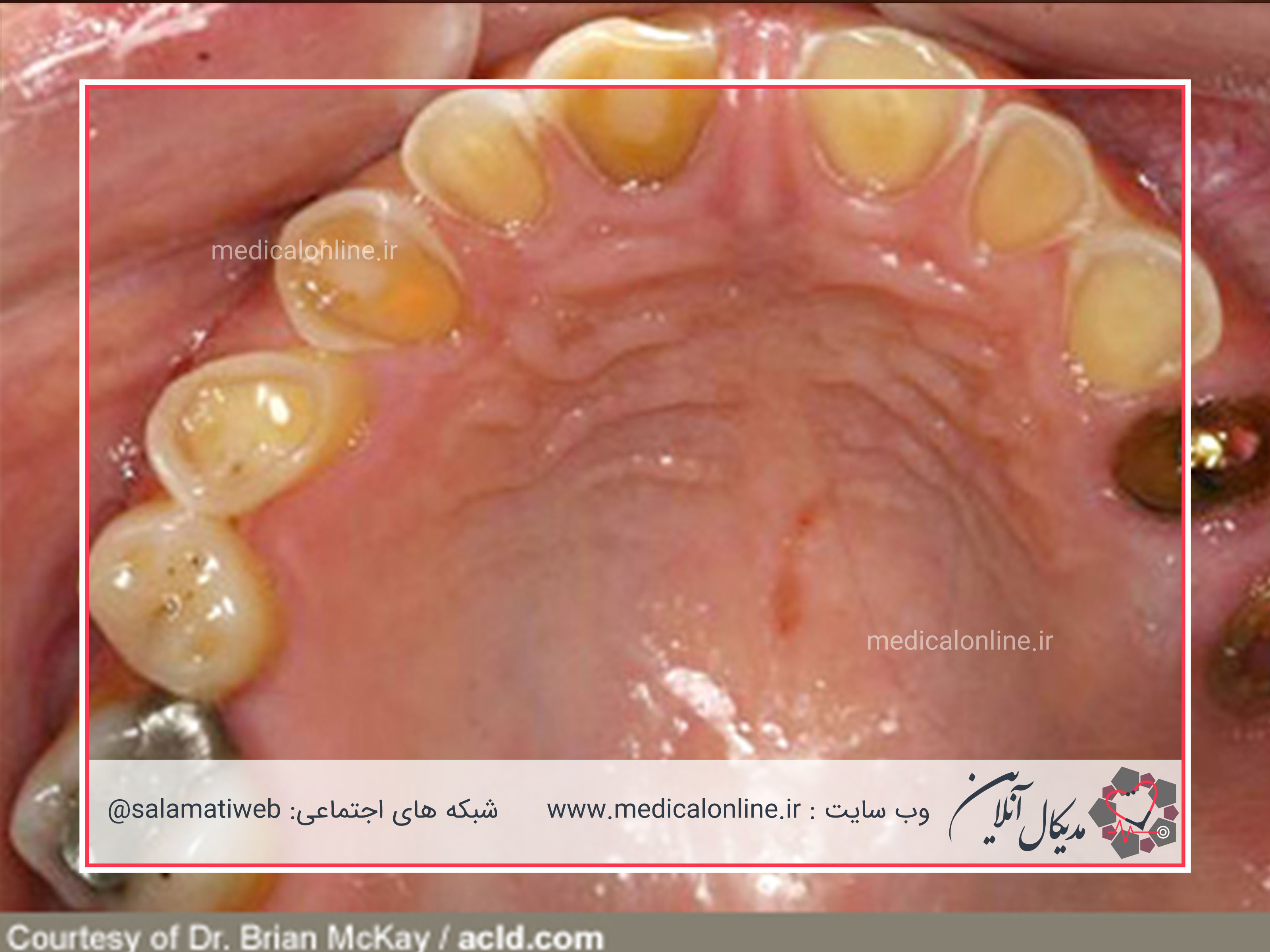 اختلال و فرسایش مینای دندان