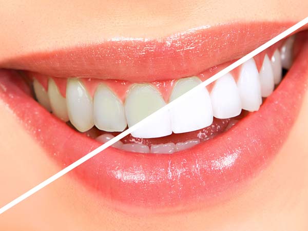 کدام روش سفید کردن دندان ها بهتر است؟