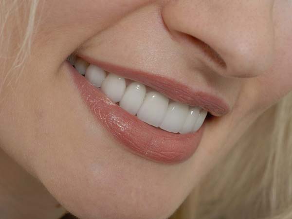 سوالات رایج در مورد لمینت سرامیکی دندان