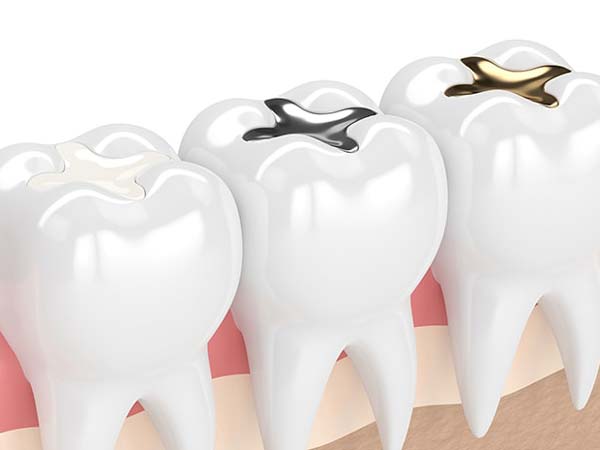 مزایای استفاده از ترمیم‌ همرنگ دندان‌