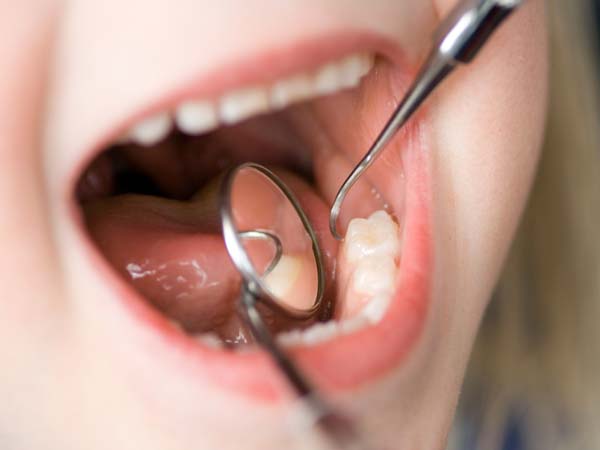 معایب استفاده از ترمیم همرنگ دندان
