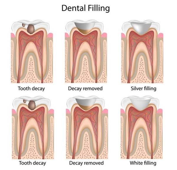 مراحل ترمیم همرنگ دندان