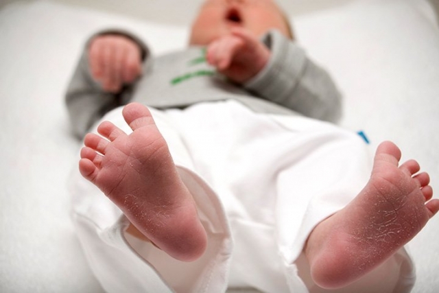 خشکی پوست در نوزادان و کودکان