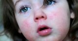 بیماری مخملک در کودکان